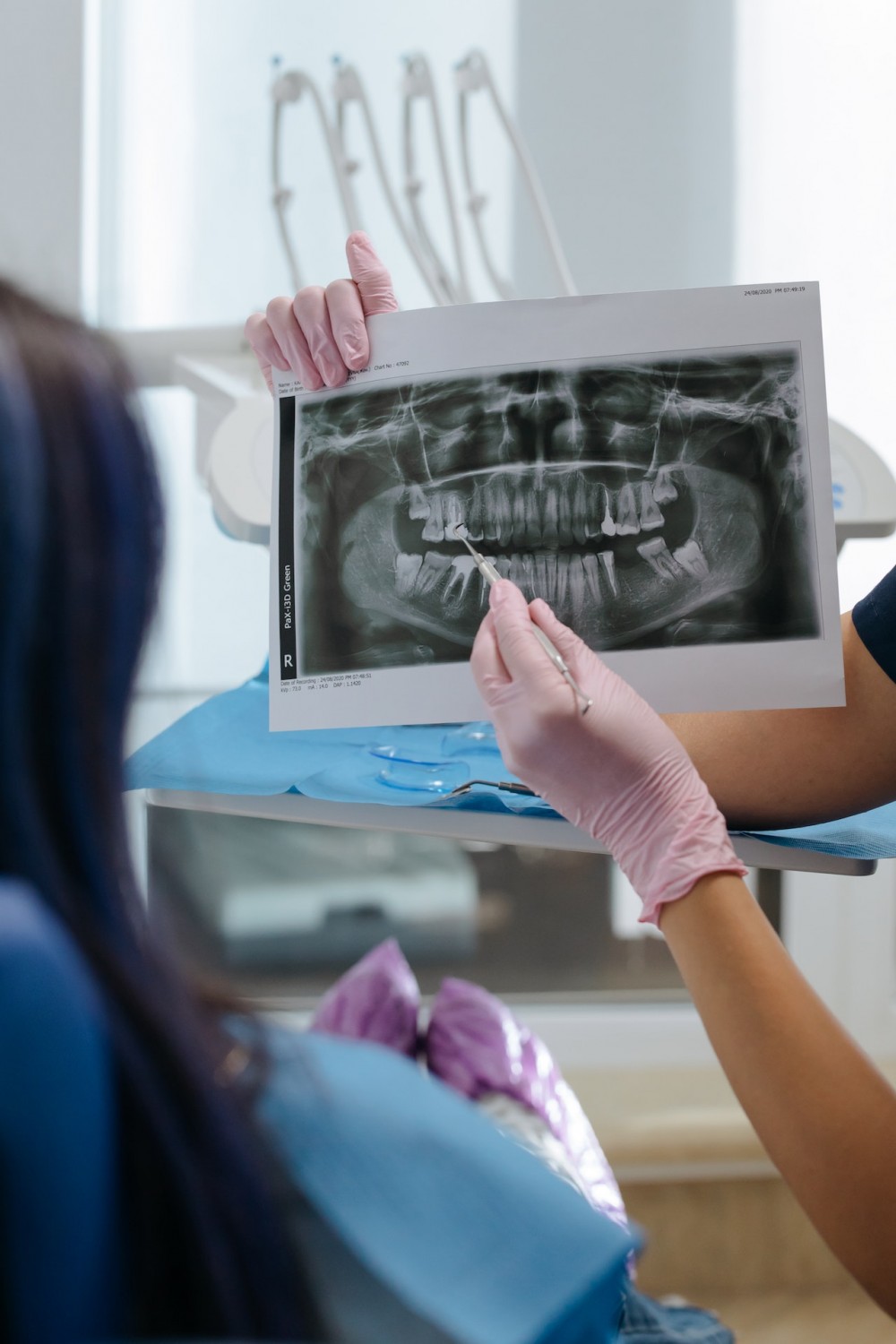 Какие 3 вопроса нужно задать стоматологу, прежде чем поставить виниры?