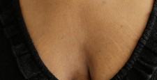 Почему появляются растяжки на груди, и можно ли от них избавиться?